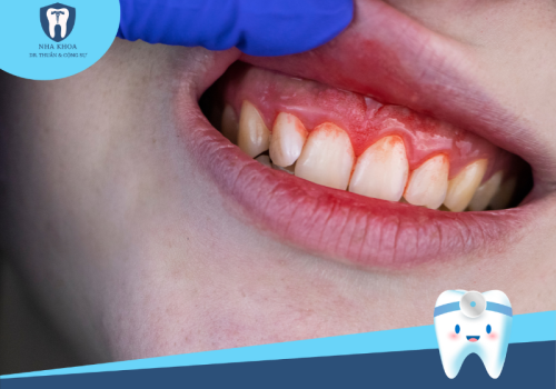 Điều trị viêm nướu: Giải pháp điều trị hiệu quả cho sức khỏe răng miệng