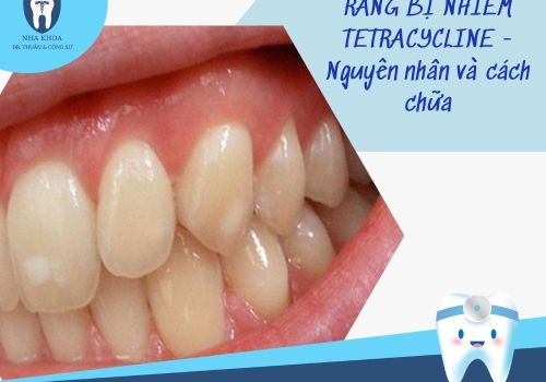 Tìm hiểu nguyên nhân và cách chữa răng bị nhiễm tetracycline
