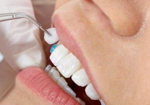 Trồng răng sứ có sử dụng vĩnh viễn được không?