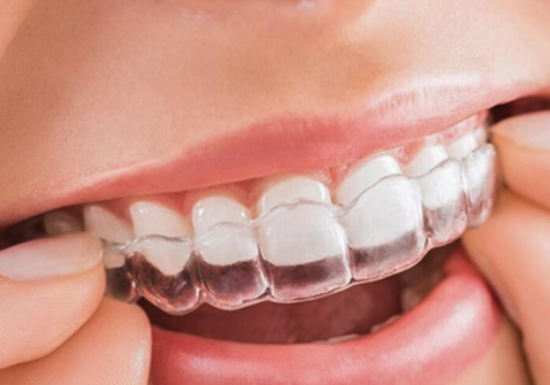 Top 3 phòng khám niềng răng invisalign tốt nhất tại Ninh Bình