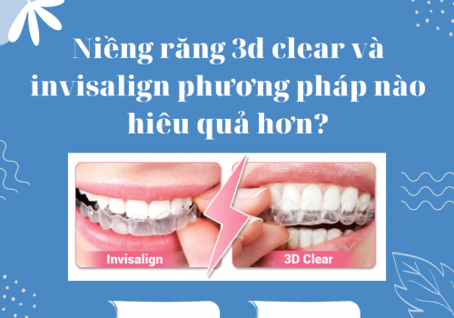 Niềng răng 3d clear và invisalign phương pháp nào hiêu quả hơn?