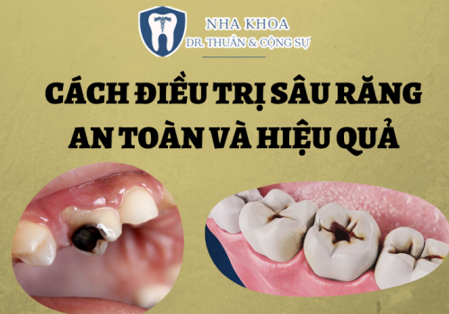Cách điều trị sâu răng an toàn và triệt để