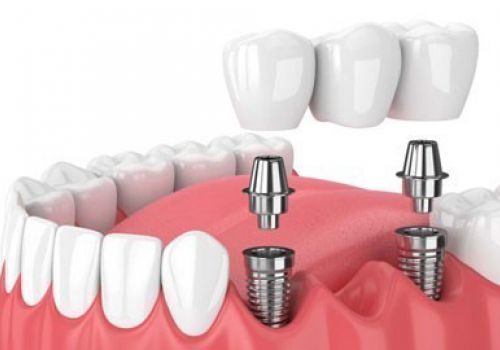 CẦN LƯU Ý NHỮNG GÌ KHI TRỒNG RĂNG IMPLANT?