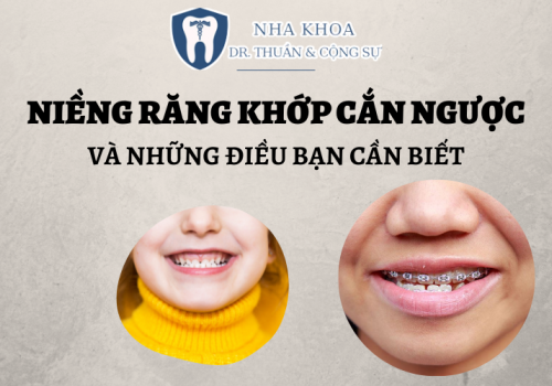 Niềng răng khớp cắn ngược và những điều bạn cần biết