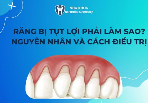 Răng bị tụt lợi phải làm sao? Nguyên nhân và cách điều trị