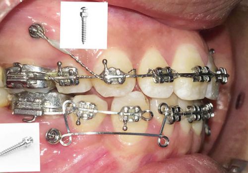 Niềng răng thì khi nào cần cắm Minivis? Khi nào thì cần thực hiện?