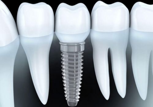 Những Điều Cần Biết Để Chăm Sóc Răng Sau Cấy Implant