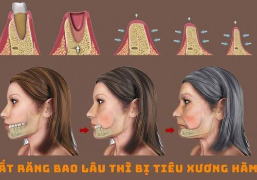 Mất răng bao lâu thì bị tiêu xương hàm? Nguyên nhân và cách khắc phục