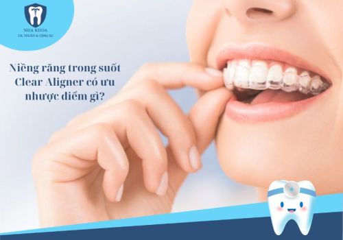 Niềng răng trong suốt Clear Aligner có ưu nhược điểm gì?