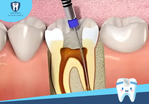 Cấy tủy răng nhân tạo - Giải pháp hiện đại cho sức khỏe răng miệng