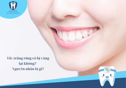 Tẩy trắng răng có bị vàng lại không? Nguyên nhân là gì?