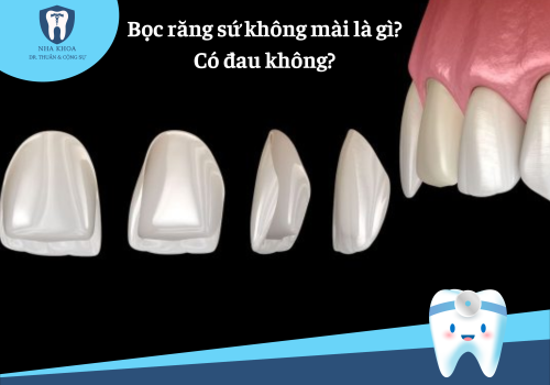 Bọc răng sứ không mài là gì? Ưu điểm của kỹ thuật này có gì nổi bật?