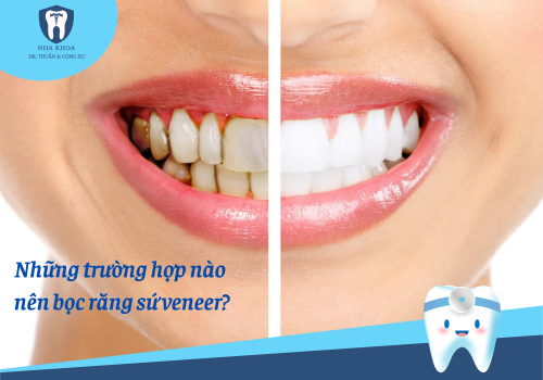 Đối tượng nào nên bọc răng sứ veneer? Dán sứ có dễ bung, nứt không? 