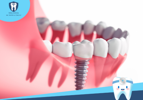 Cấy ghép răng Implant- Giải pháp khôi phục răng hiệu quả