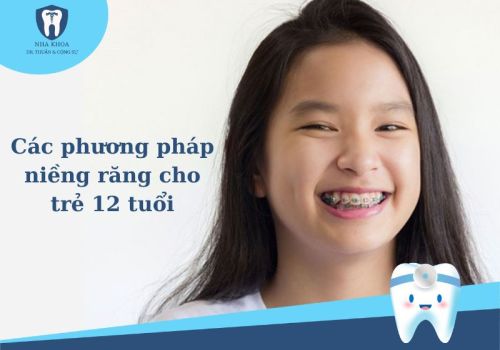 Các phương pháp niềng răng cho trẻ 12 tuổi và giá niềng răng