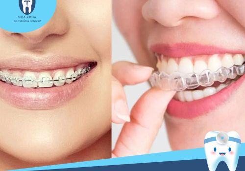 Sự khác biệt giữa niềng răng trong suốt và niềng răng mắc cài