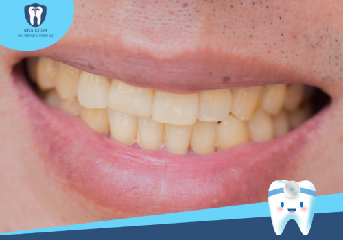 Nguyên nhân răng bị ố vàng? Cách làm trắng răng ố vàng lâu năm?