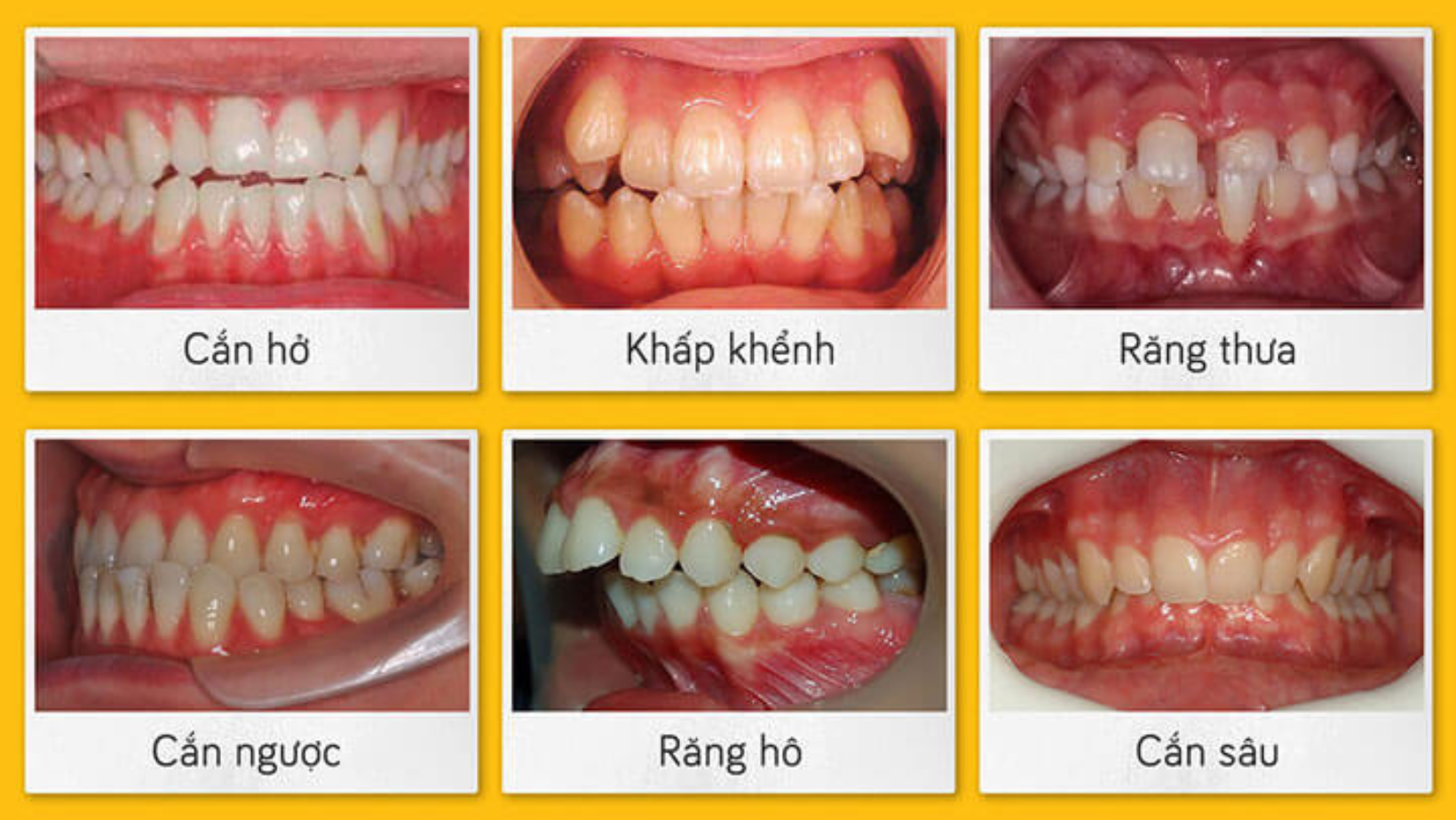 niềng răng invisalign