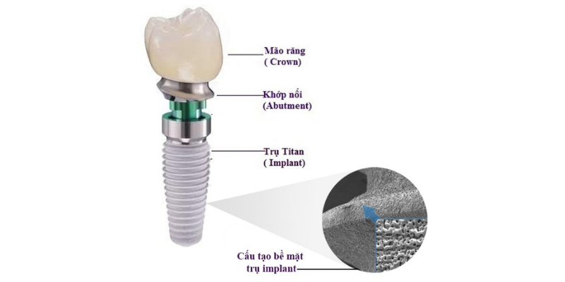 cau tao rang implant