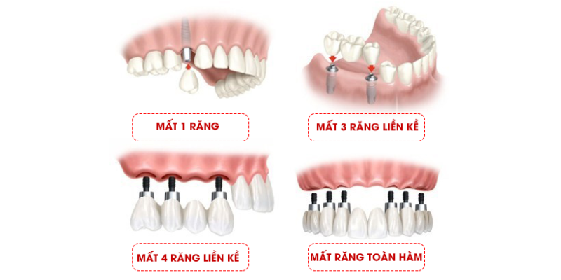 truong hop nen cay ghep implant