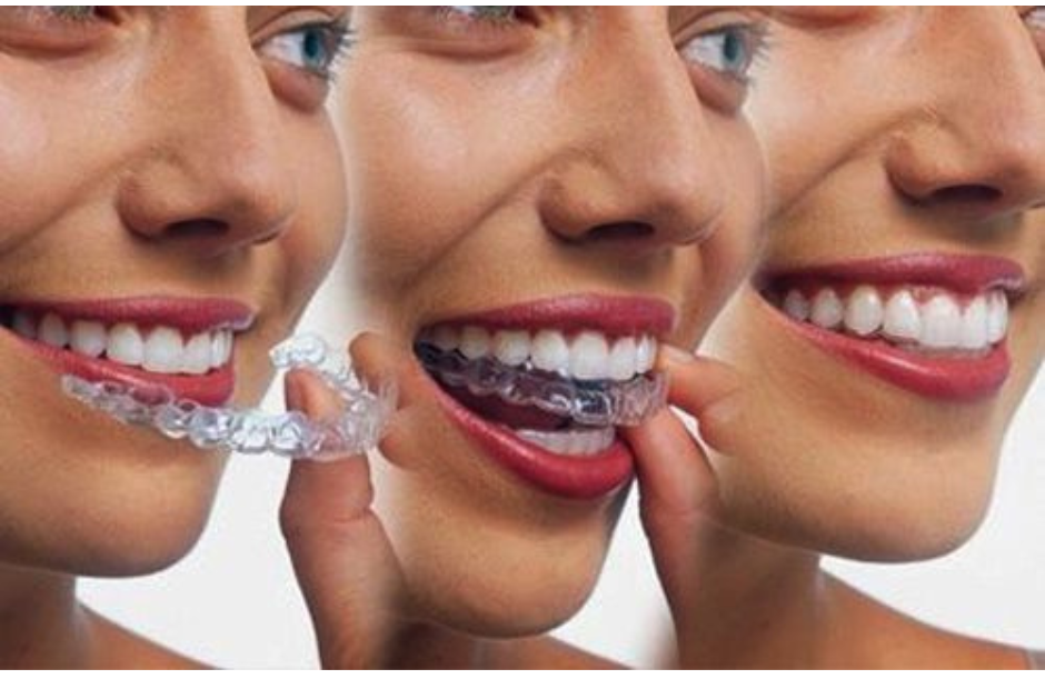 niềng răng invisalign