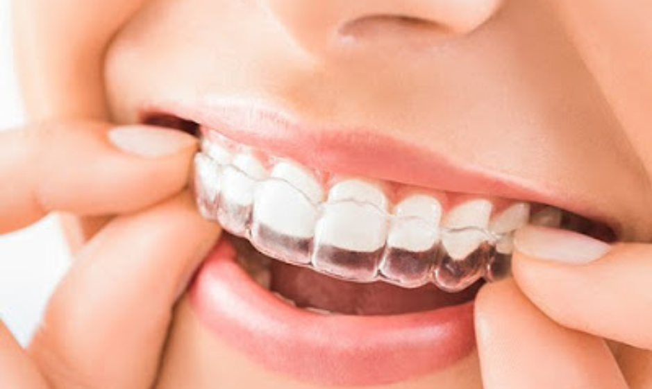 niềng răng invisalign