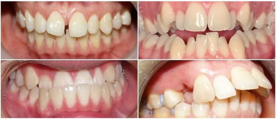 chi phí niềng răng invisalign