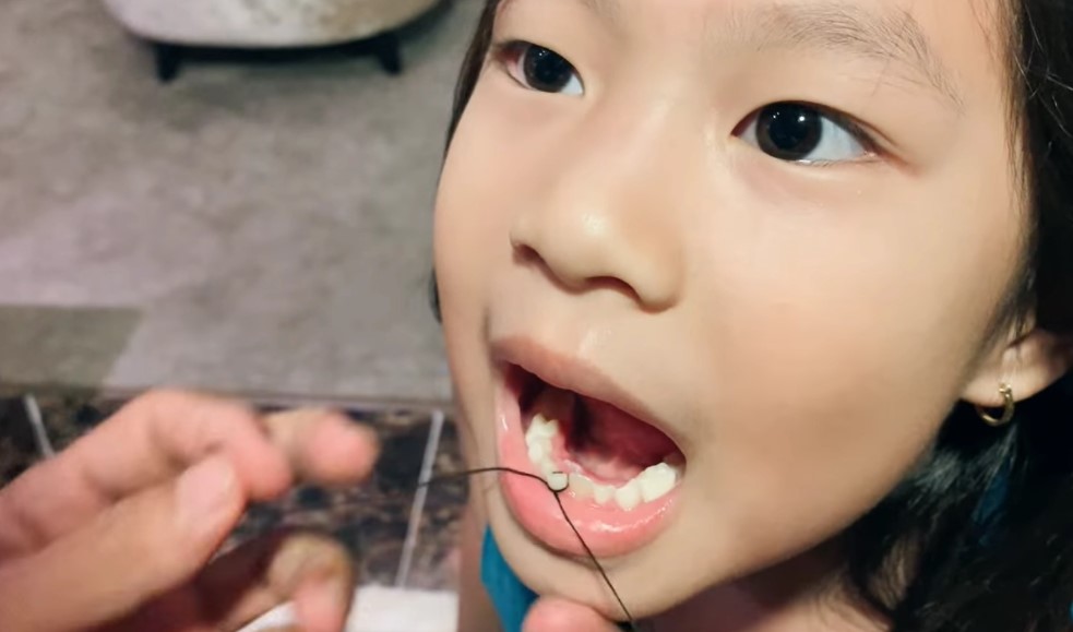 cách nhổ răng sữa cho bé