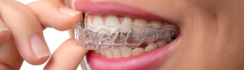 niềng răng 3d clear và invisalign