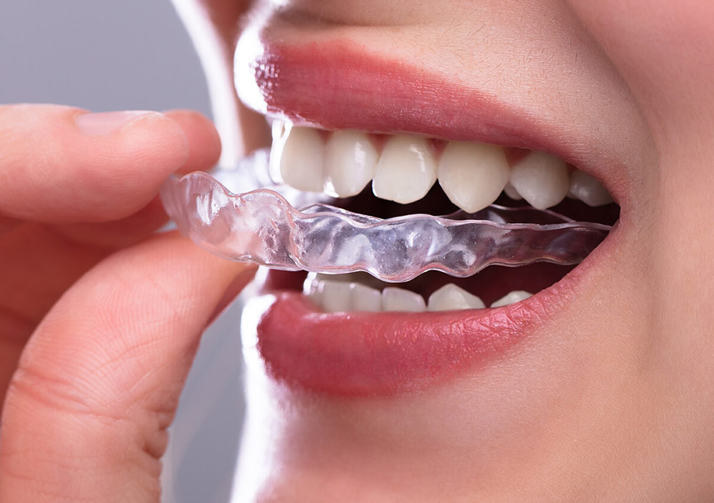 chi phí niềng răng invisalign