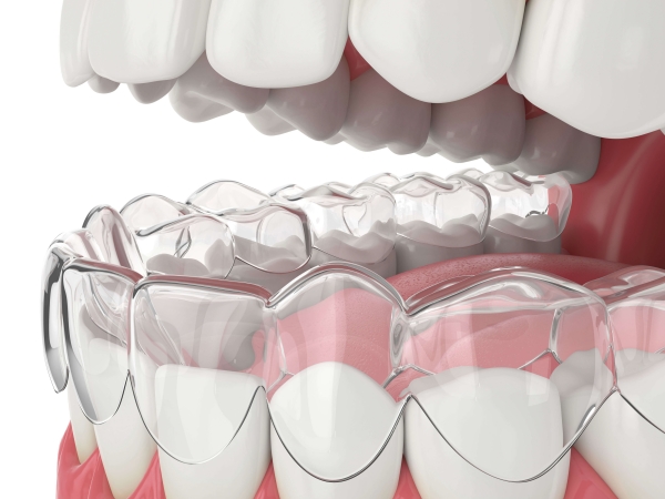 niềng răng 3d clear và invisalign