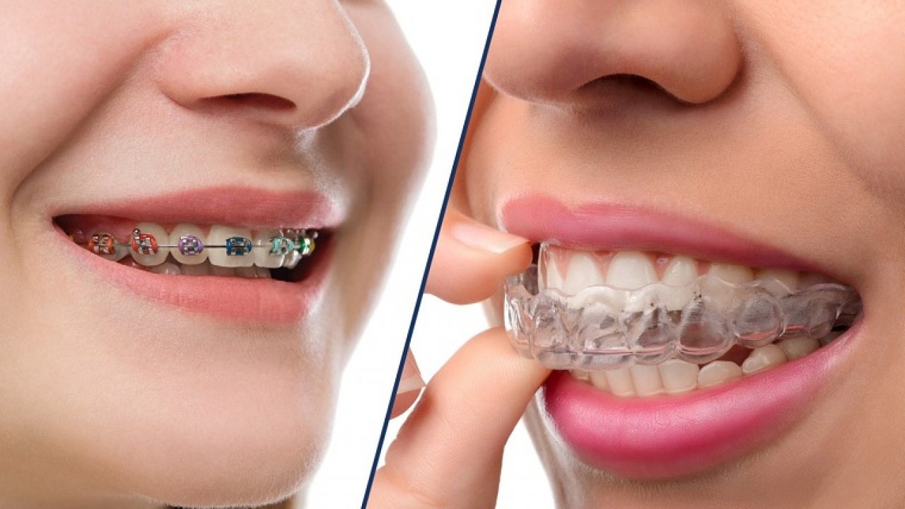 chi phí niềng răng invisalign