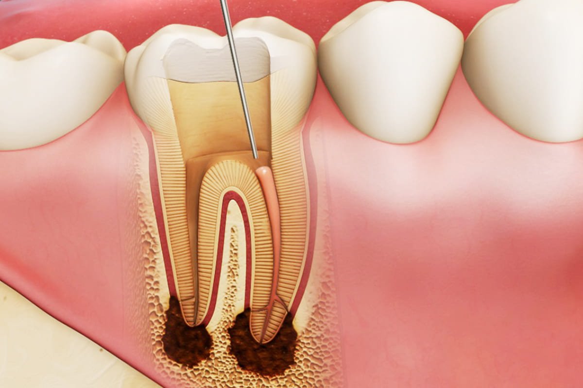 răng sữa bị sâu có nên nhổ