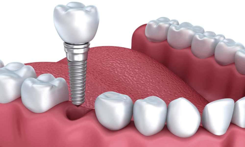 chi phí cấy ghép implant