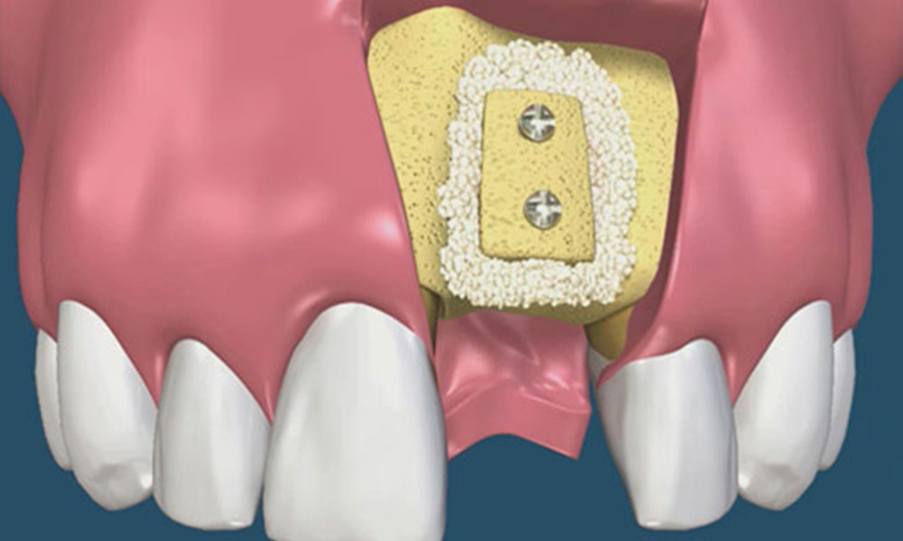 ghép xương cấy implant có đau không