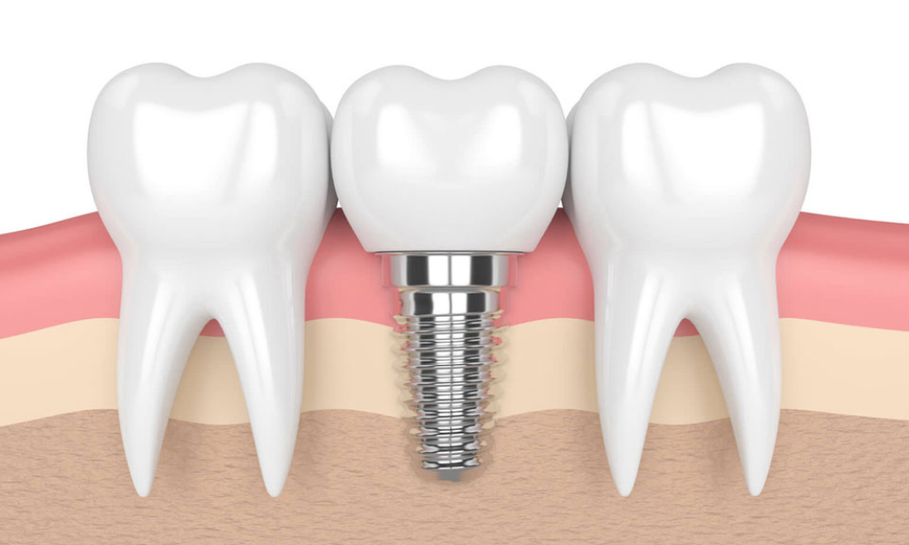 quy trình cấy ghép răng implant