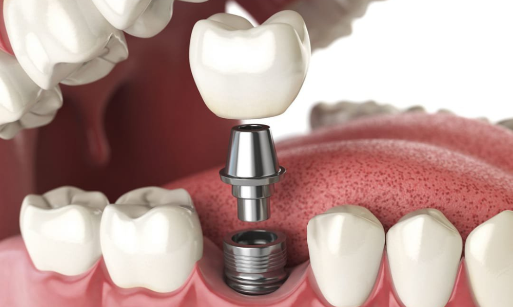 ưu nhược điểm của trồng răng implant