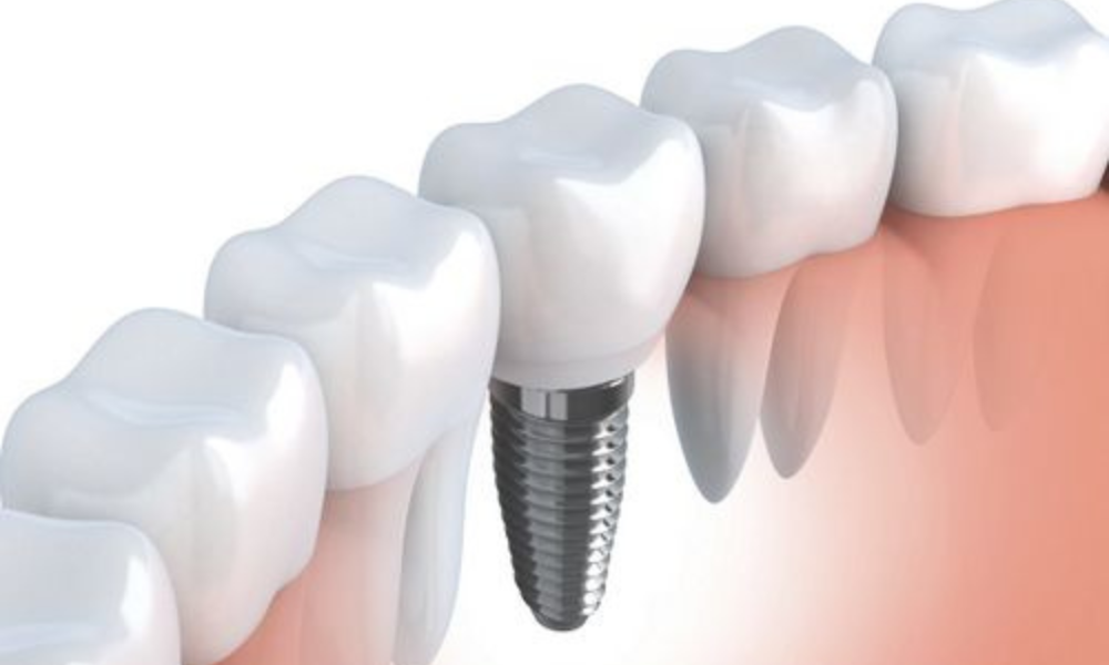 biến chứng sau cấy implant