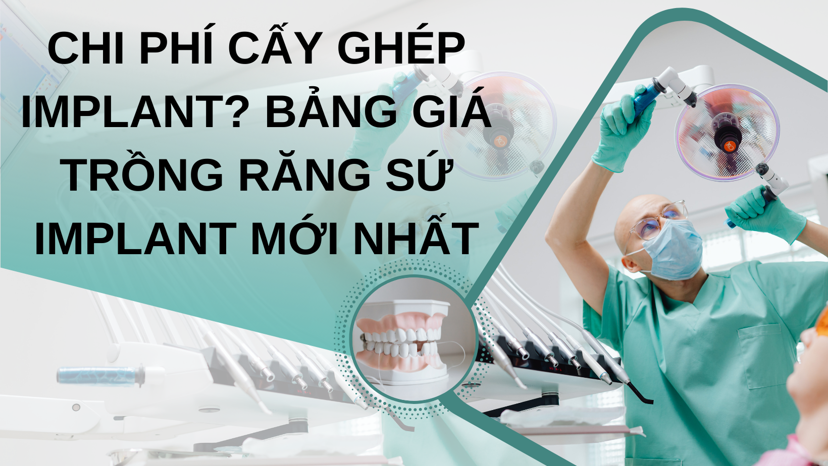 chi phí cấy ghép implant