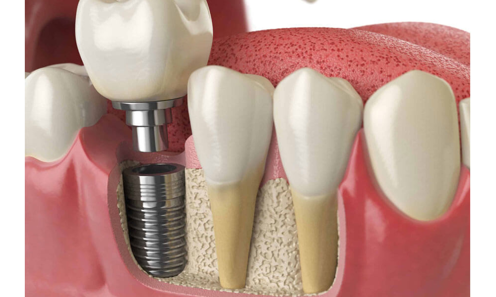 chi phí cấy ghép implant