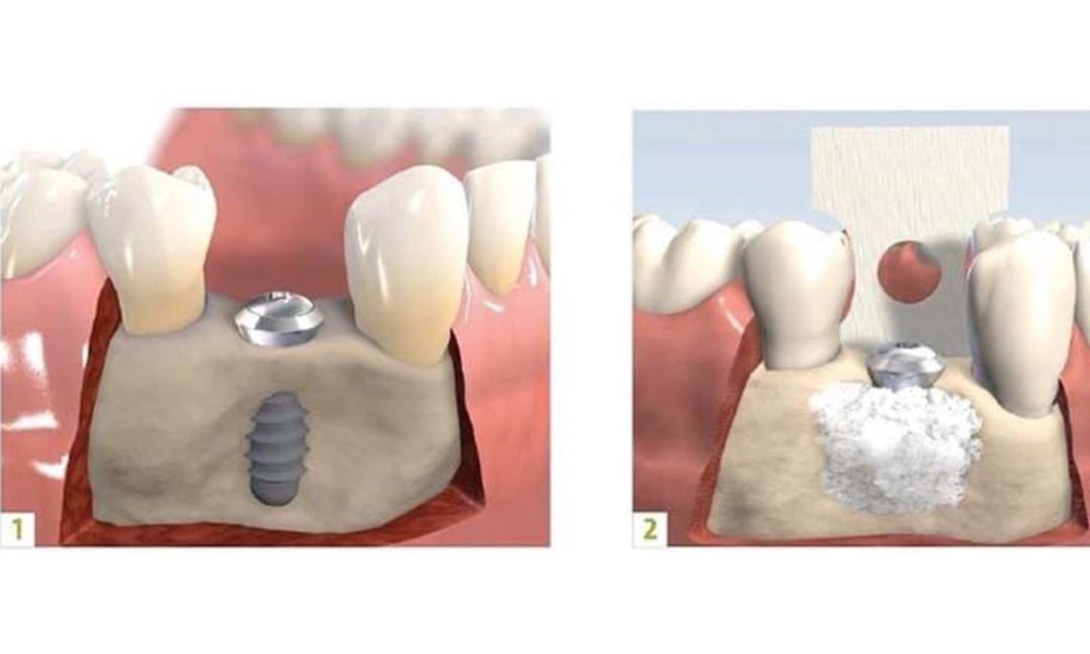 ghép xương cấy implant có đau không