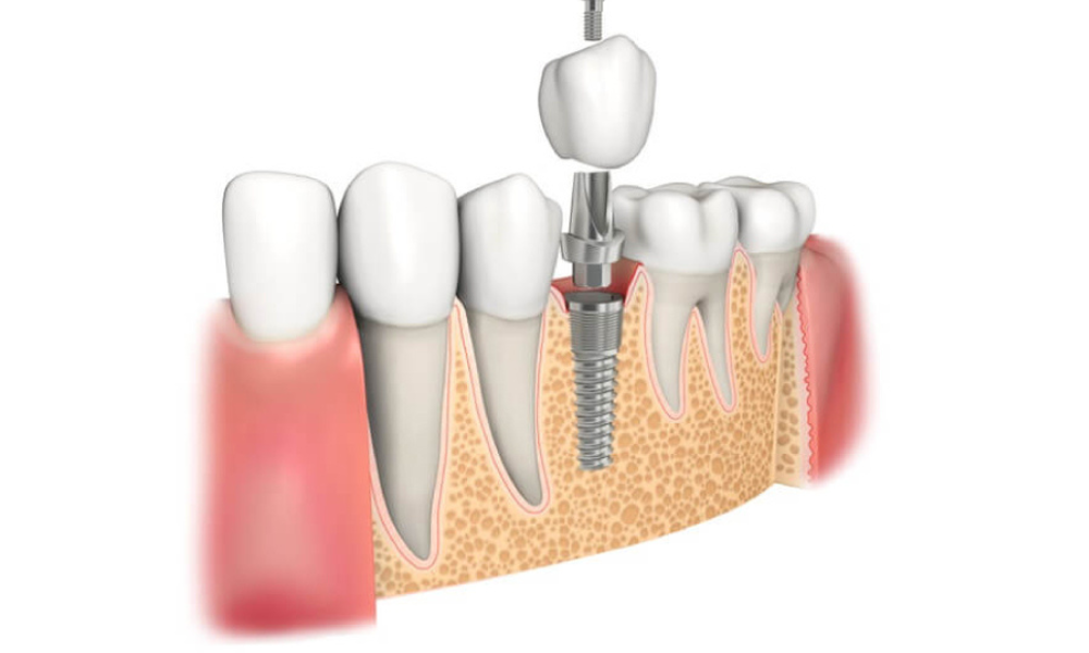 quy trình cấy ghép răng implant