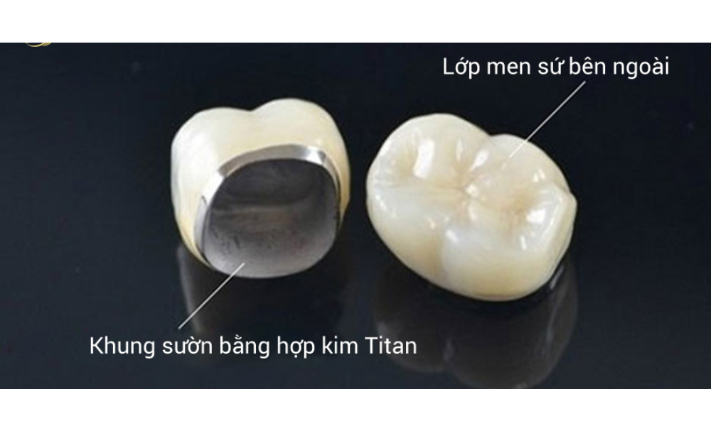 răng sứ kim loại có tốt không