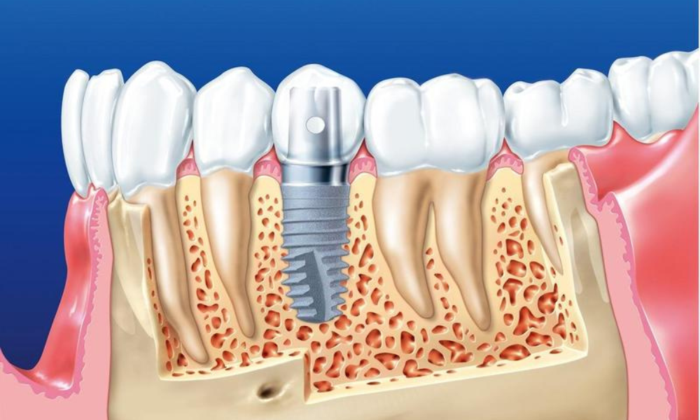 ưu nhược điểm của trồng răng implant