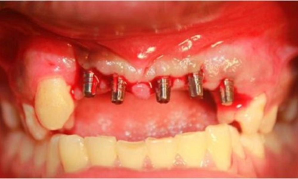 biến chứng sau cấy implant