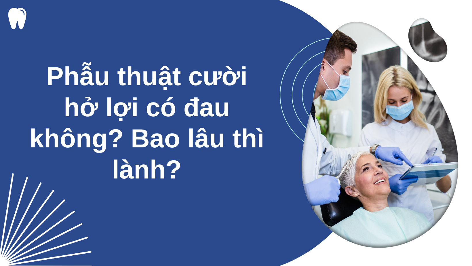 phẫu thuật cười hở lợi có đau không