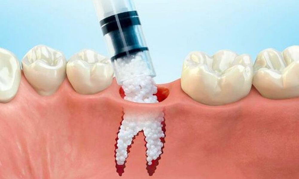 ghép xương cấy implant có đau không