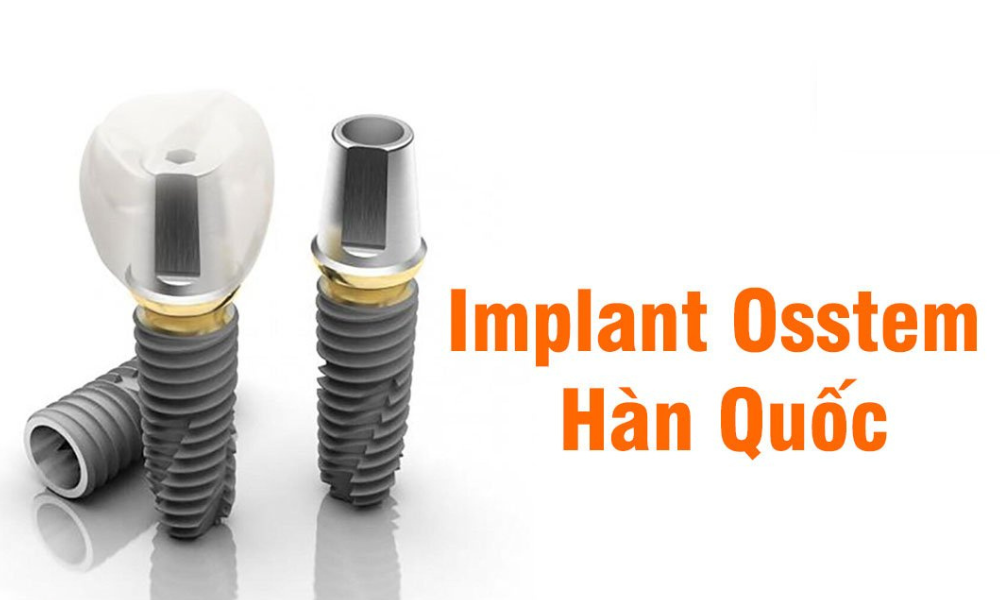 quy trình cấy ghép răng implant