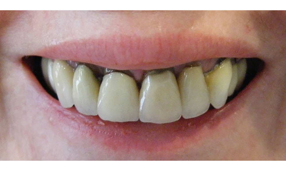 so sánh răng sứ kim loại và răng toàn sứ