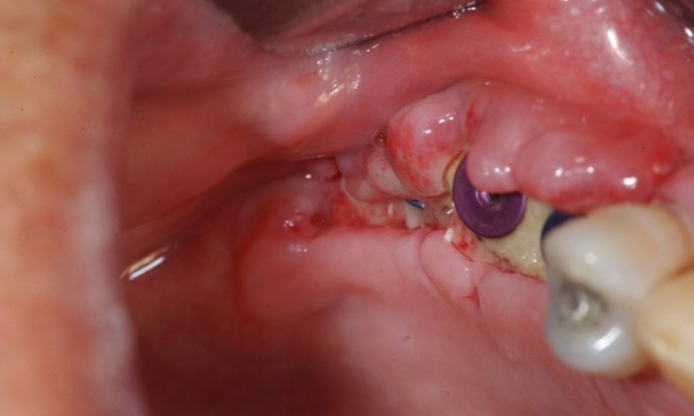 biến chứng sau cấy implant